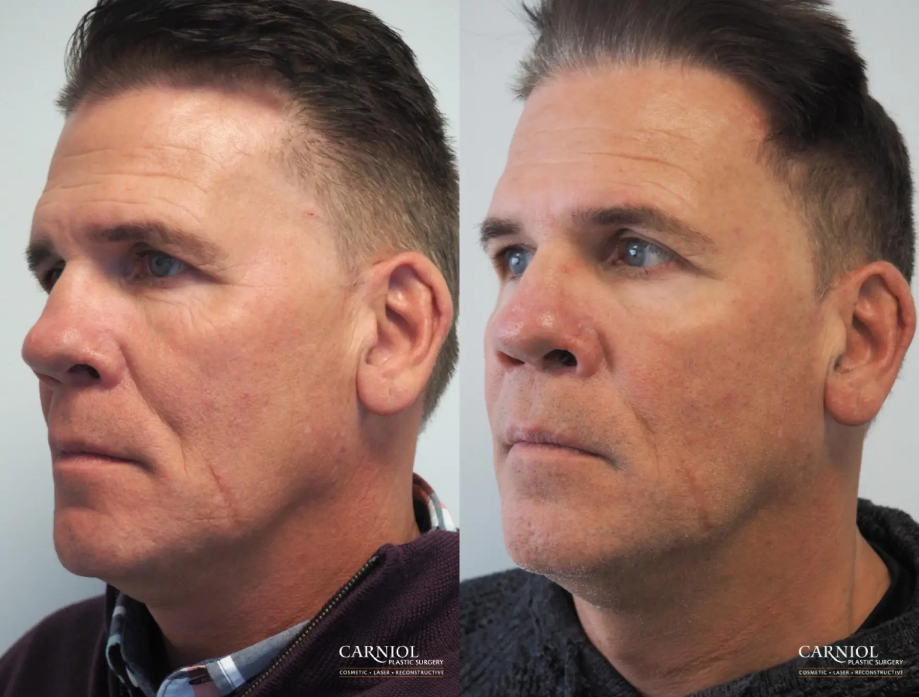 Non-Surgical Facelift: Patient 2 - Before and After 1