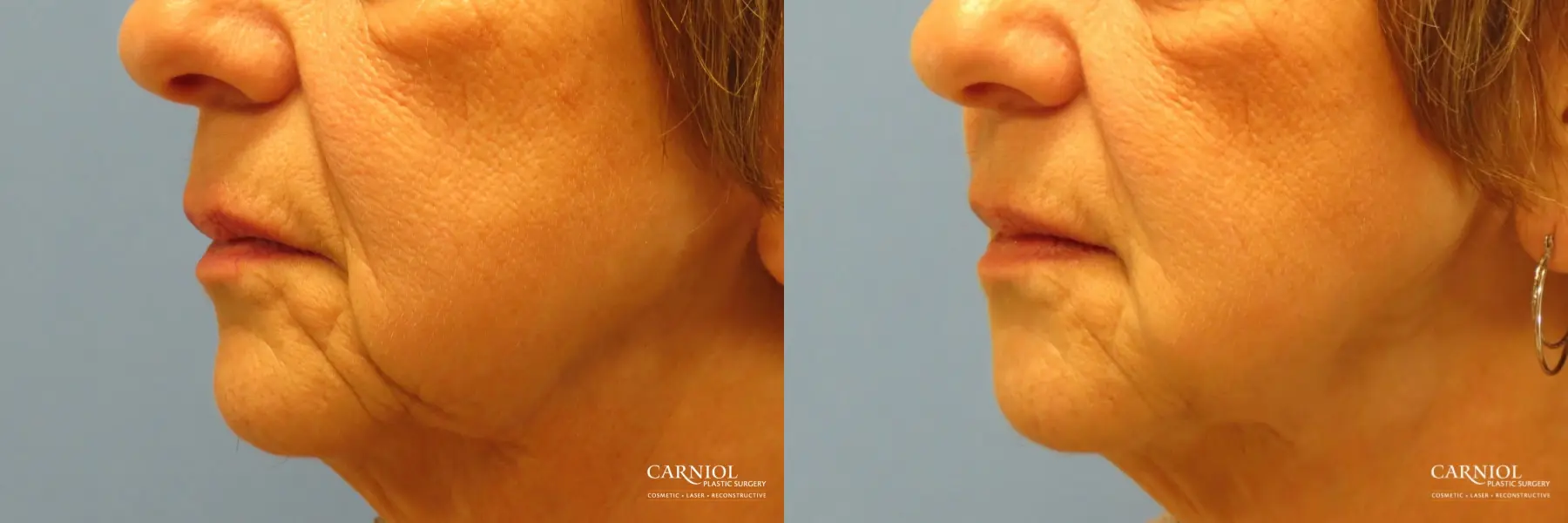 Non-Surgical Facelift: Patient 1 - Before and After 3