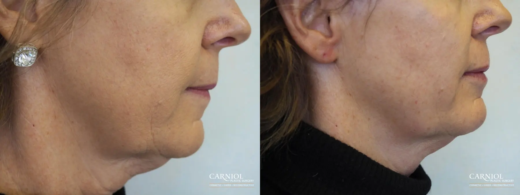 Non-Surgical Facelift: Patient 7 - Before and After 1