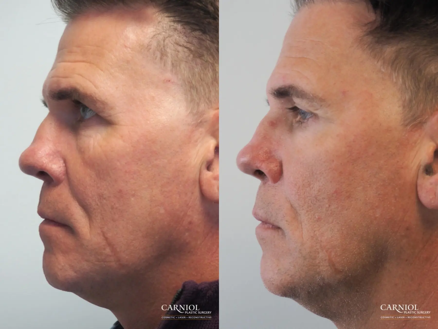 Non-Surgical Facelift: Patient 2 - Before and After 3