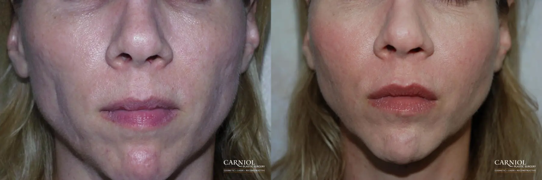 Non-Surgical Facelift: Patient 10 - Before and After 1