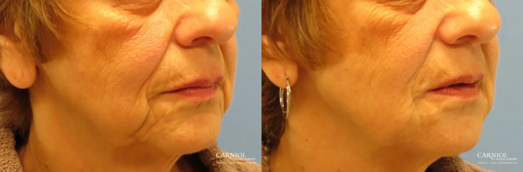 Non-Surgical Facelift: Patient 1 - Before and After 2
