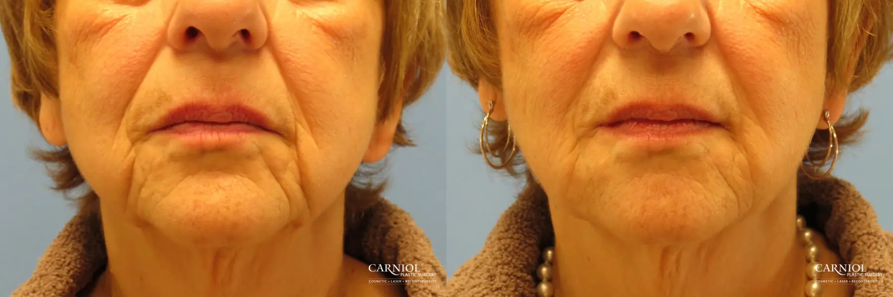 Non-Surgical Facelift: Patient 1 - Before and After  