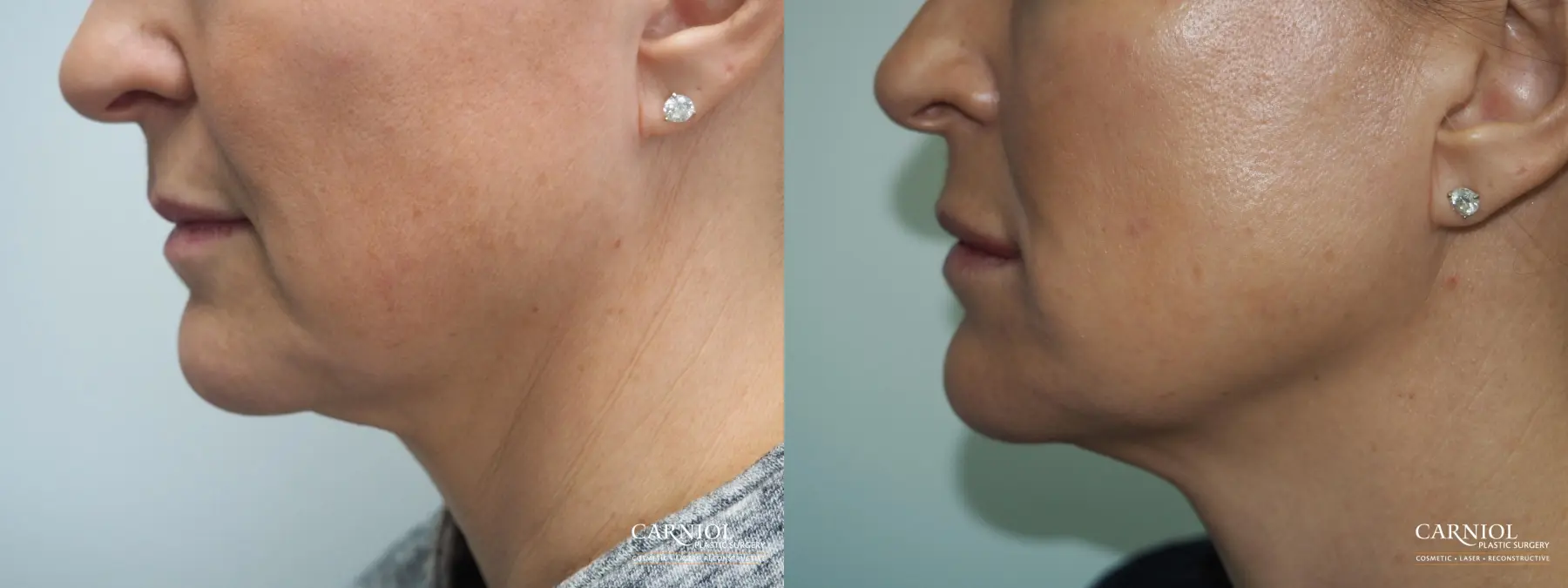 Cheek Boost - Before and After 1