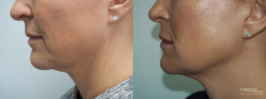 Cheek Boost - Before and After  