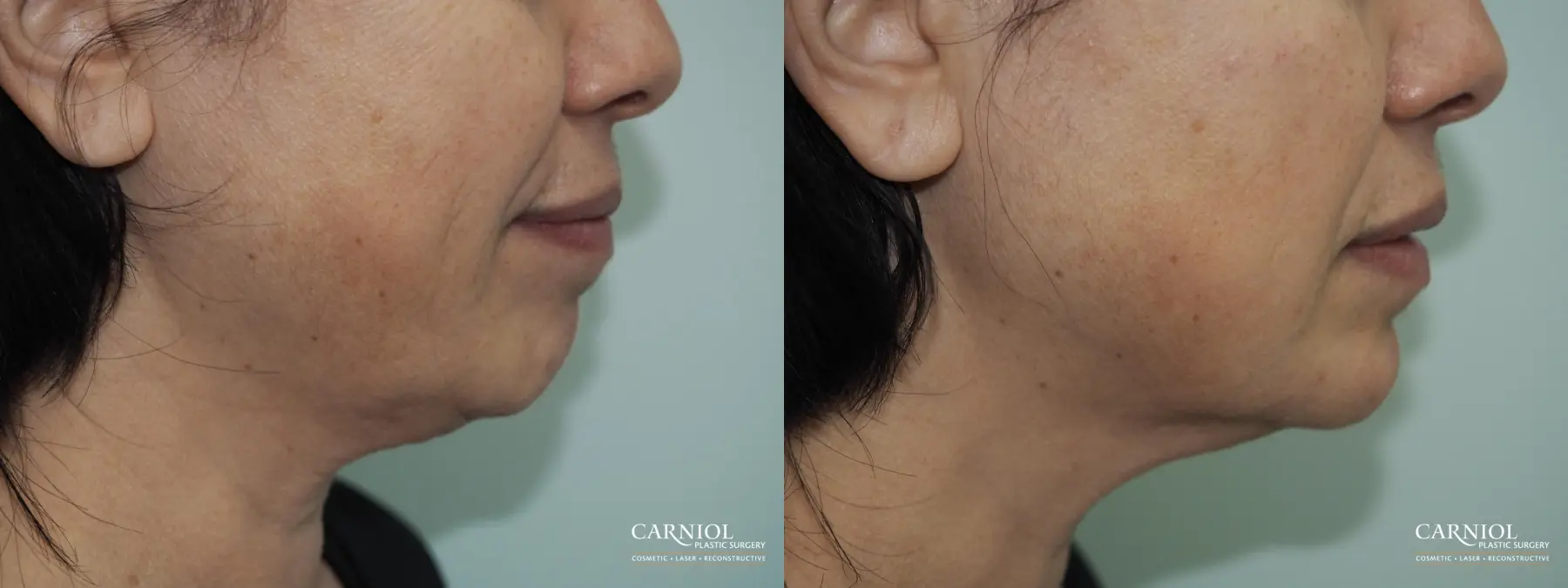 Non-Surgical Facelift: Patient 3 - Before and After  