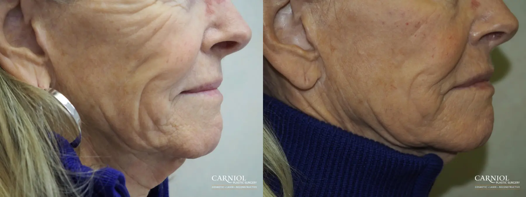 Non-Surgical Facelift: Patient 8 - Before and After 1