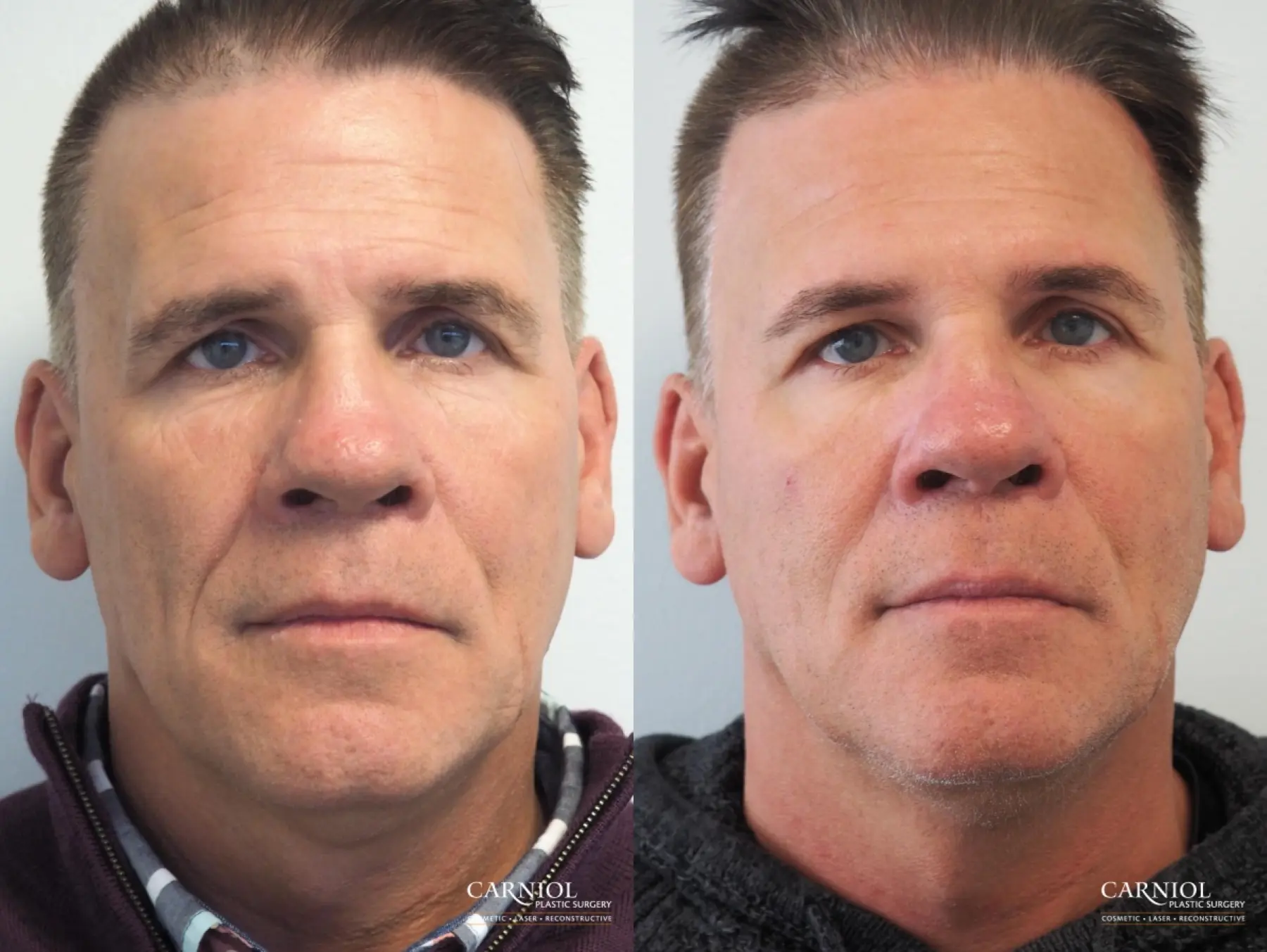 Non-Surgical Facelift: Patient 2 - Before and After 2