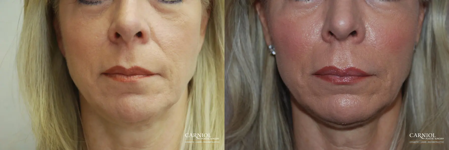 Non-Surgical Facelift: Patient 9 - Before and After 1
