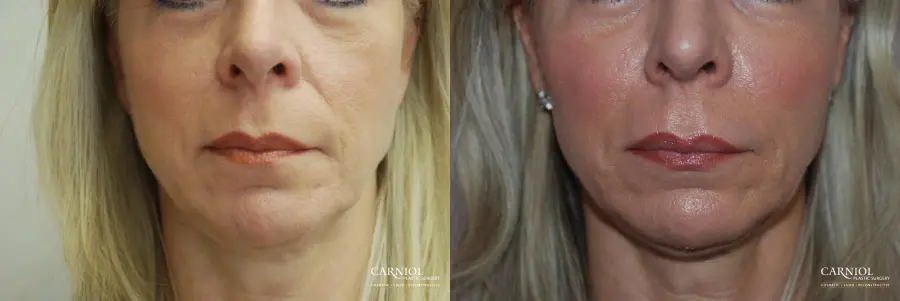 Non-Surgical Facelift: Patient 9 - Before and After  