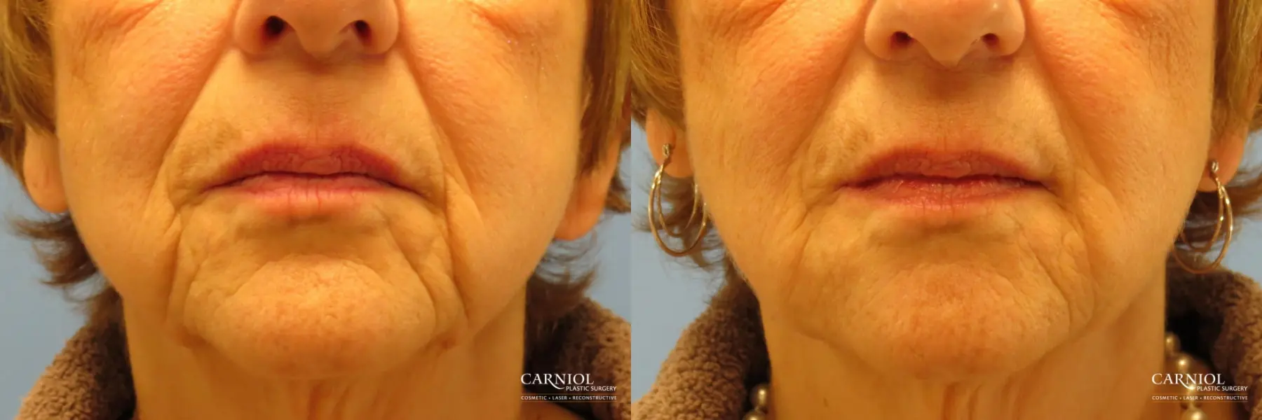 Non-Surgical Mini-Facelift: Patient 9 - Before and After  