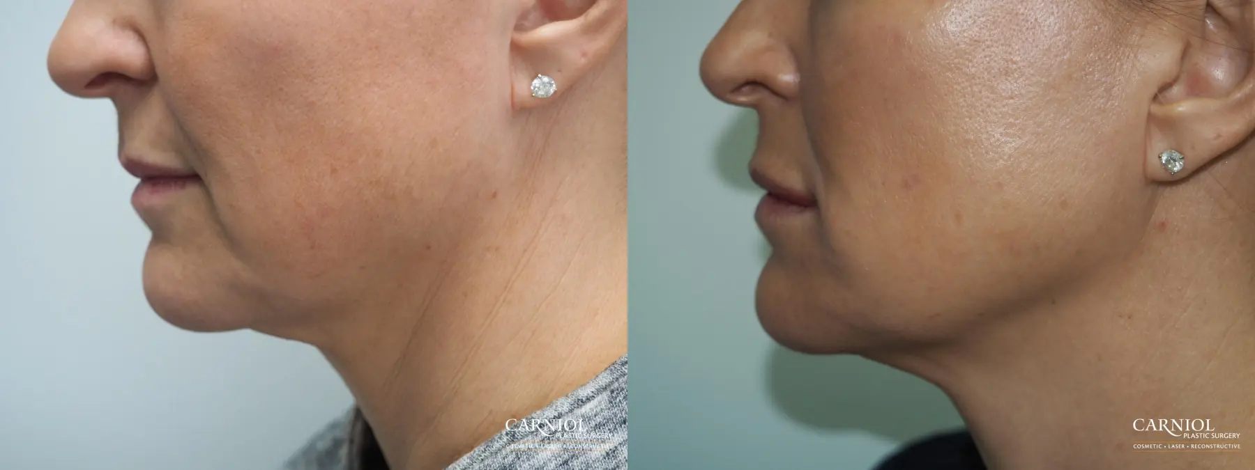 Non-Surgical Mini-Facelift: Patient 2 - Before and After  