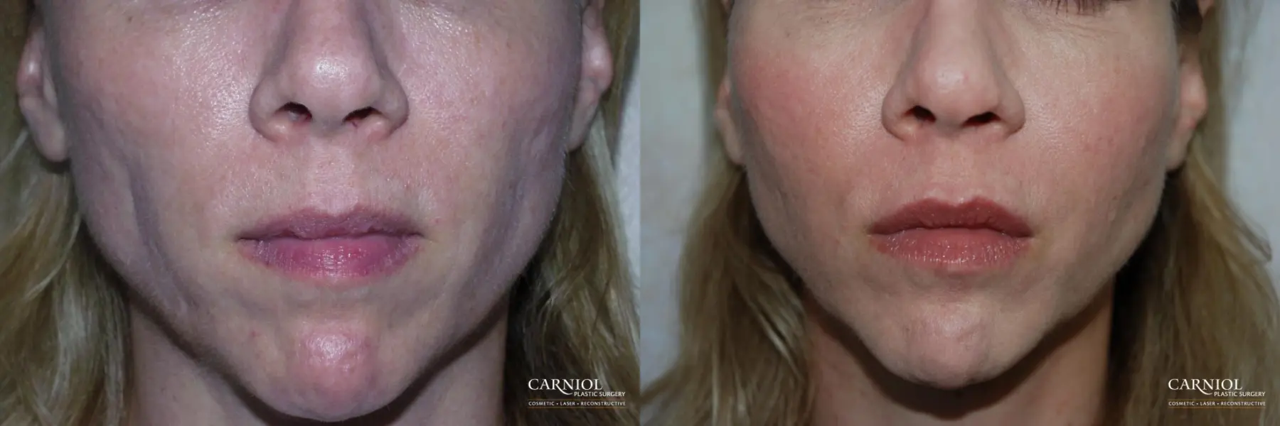 Non-Surgical Mini-Facelift: Patient 8 - Before and After  