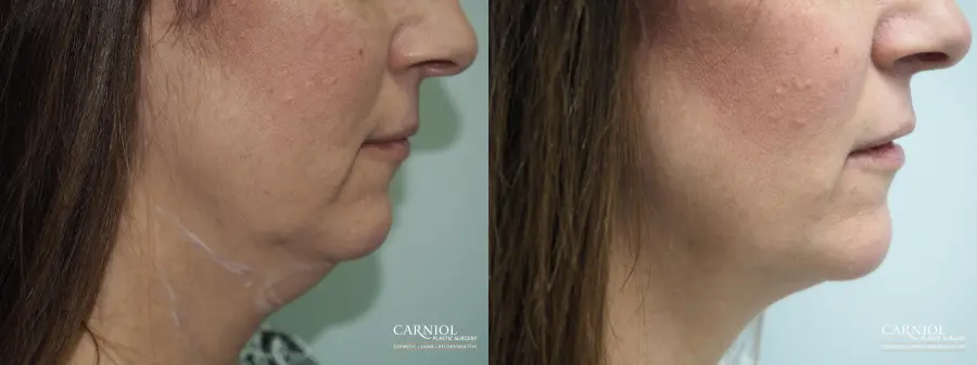 Non-Surgical Neck Lift: Patient 1 - Before and After  