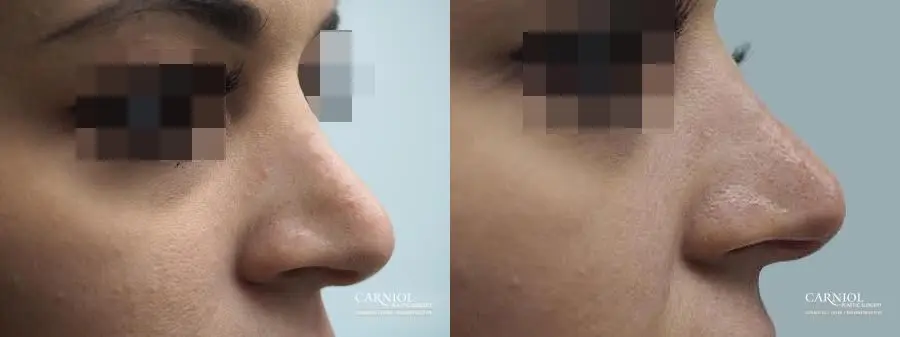 Non-Surgical Rhinoplasty: Patient 1 - Before and After  