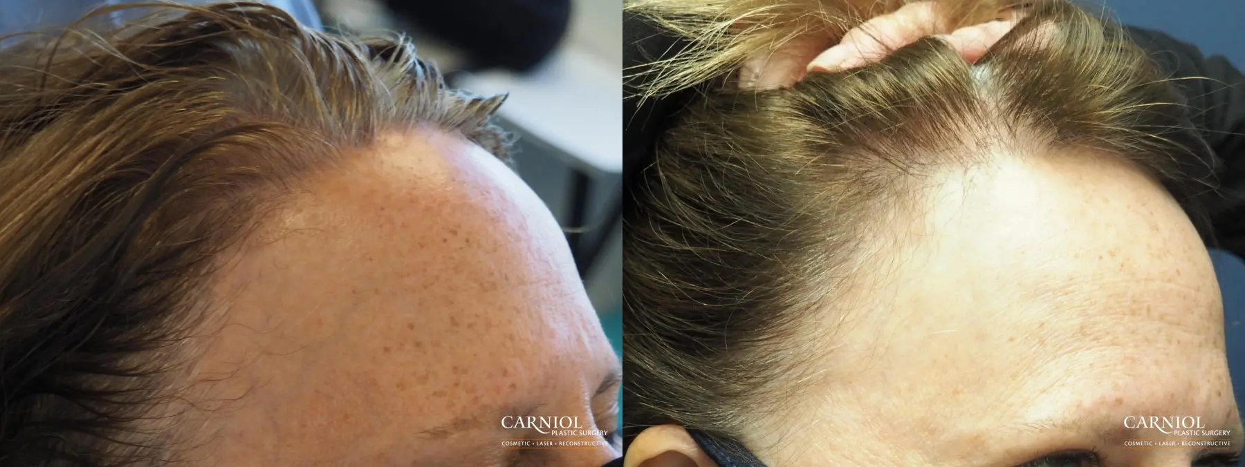 Nonsurgical Hair Restoration: Patient 1 - Before and After 2