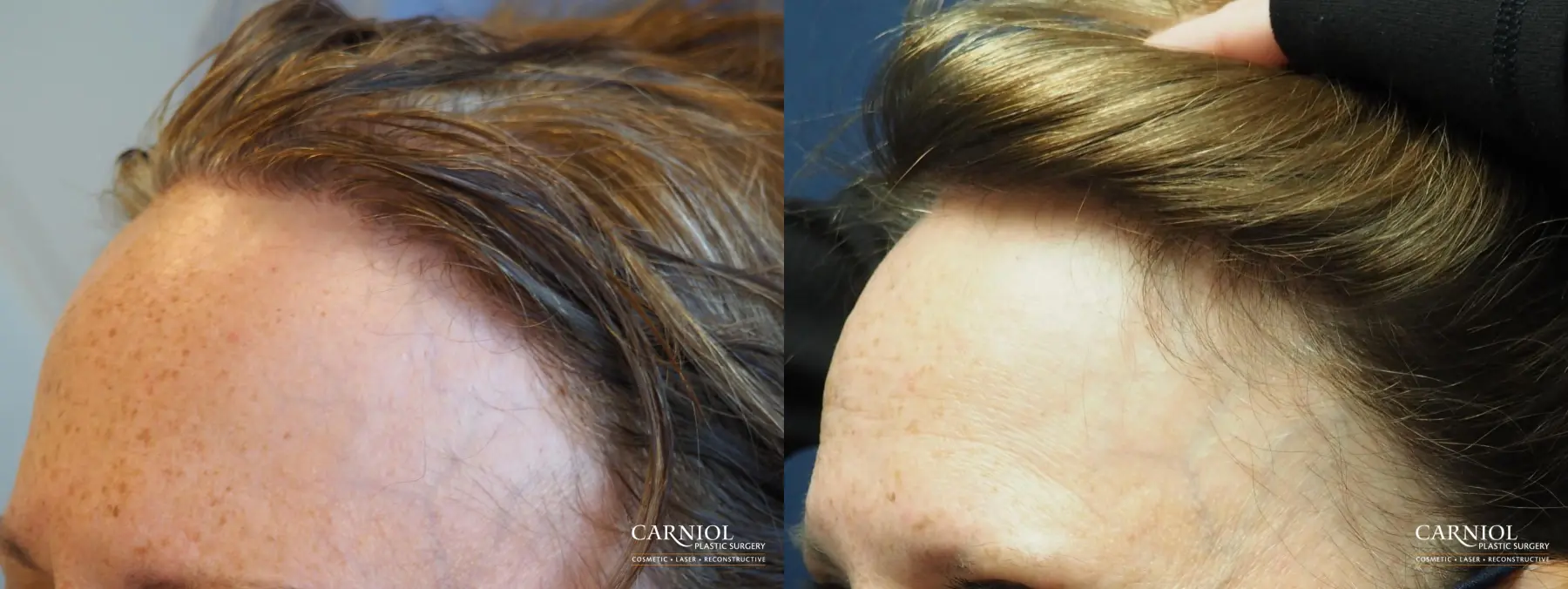 Nonsurgical Hair Restoration: Patient 1 - Before and After 3