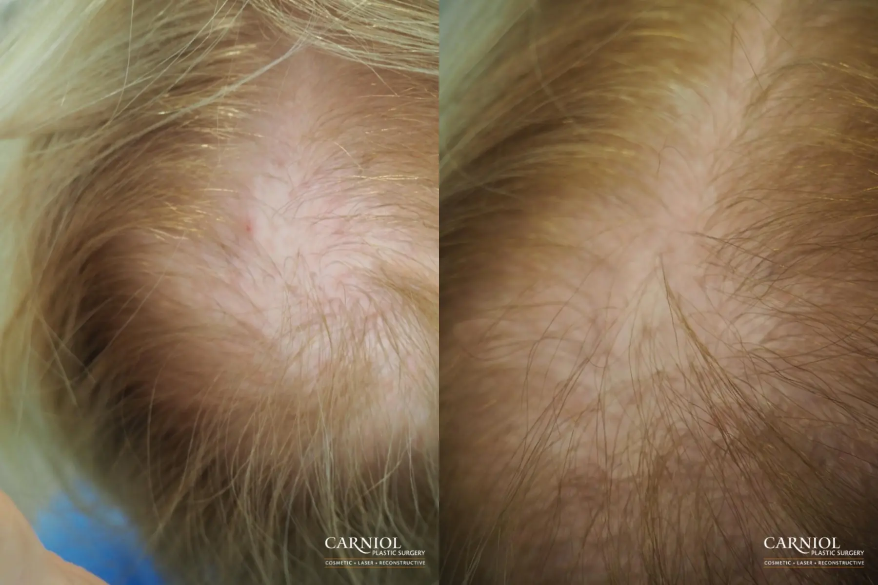 Nonsurgical Hair Restoration: Patient 2 - Before and After 1