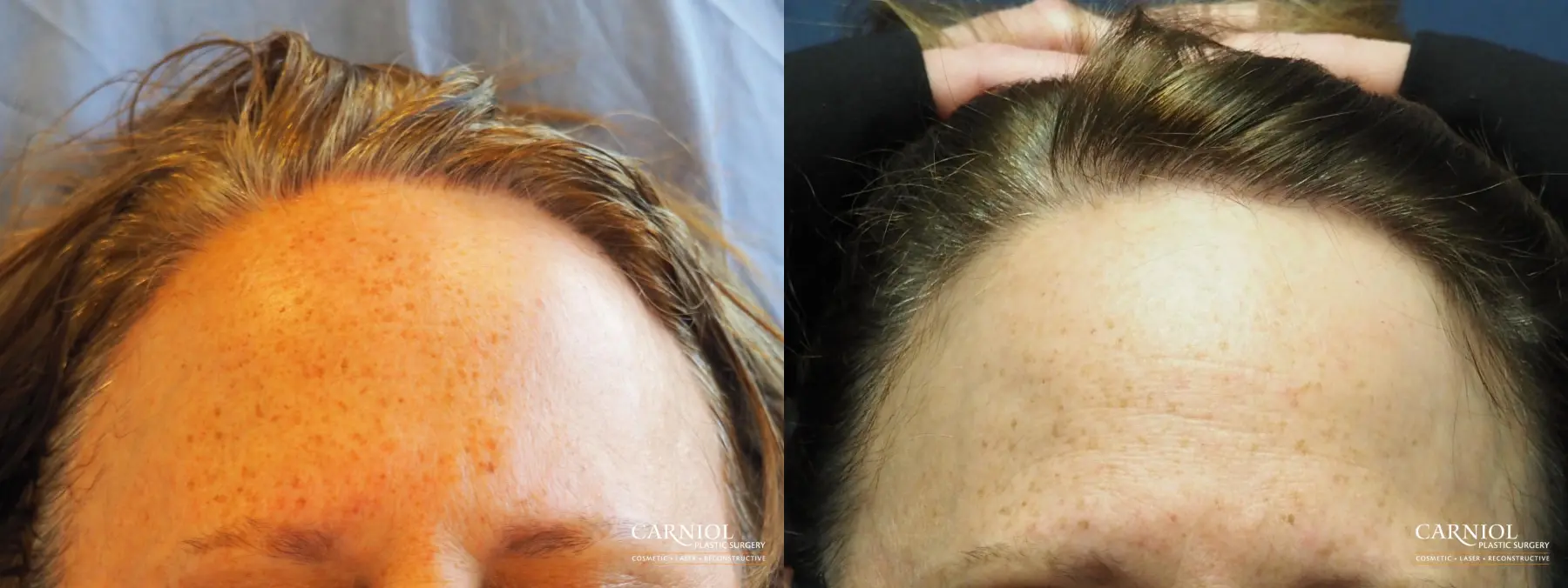 Nonsurgical Hair Restoration: Patient 1 - Before and After 1