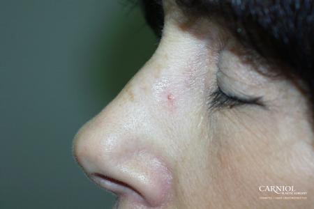 Laser Skin Resurfacing - Face: Patient 1 - After Image 1