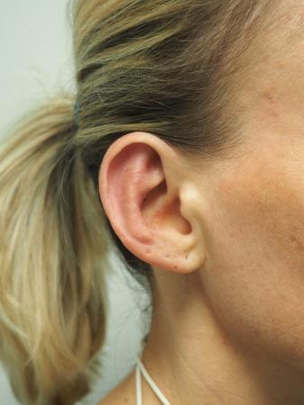 Otoplasty: Patient 3 - After Image 5