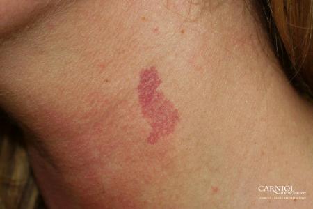 Port Wine Stain: Patient 1 - Before Image 1