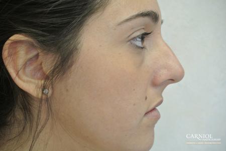 Rhinoplasty: Patient 3 - Before Image 1