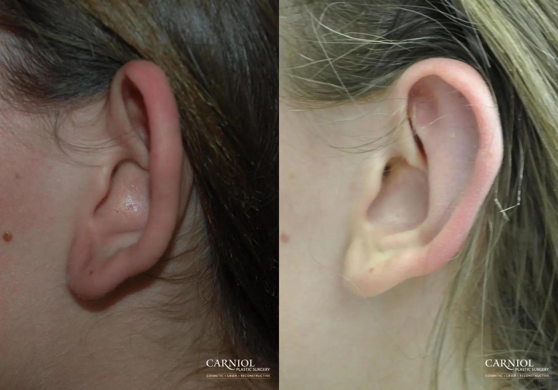 Ear Pinning - Before and After  