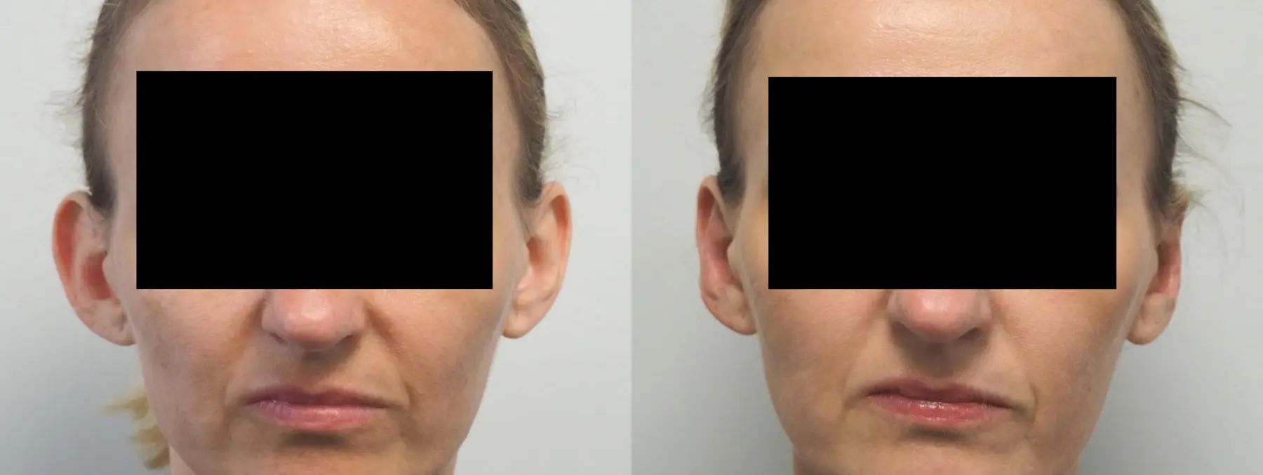 Otoplasty: Patient 3 - Before and After  