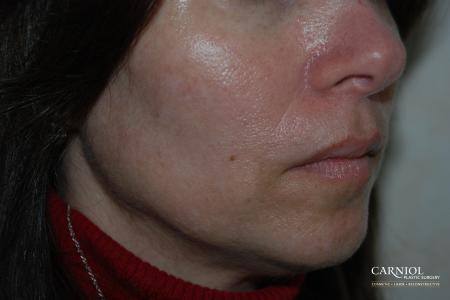 Fractional Resurfacing: Patient 4 - After Image 1