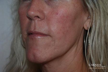 Fractional Resurfacing: Patient 3 - After Image 1