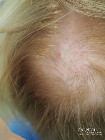 Nonsurgical Hair Restoration: Patient 1 - Before Image 1