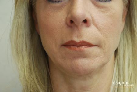 Non-Surgical Facelift: Patient 9 - Before Image 1