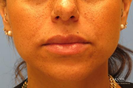 Lip Augmentation: Patient 1 - After Image 1