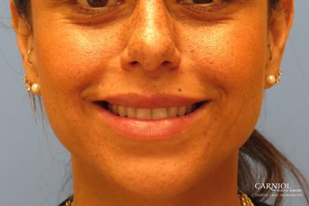 Lip Augmentation: Patient 1 - After Image 4