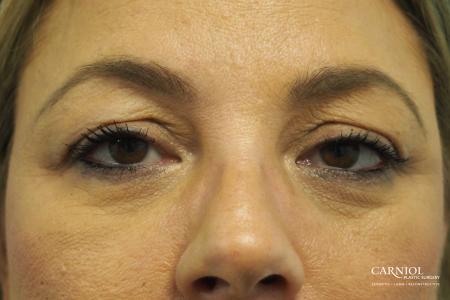 Blepharoplasty: Patient 2 - Before Image 1