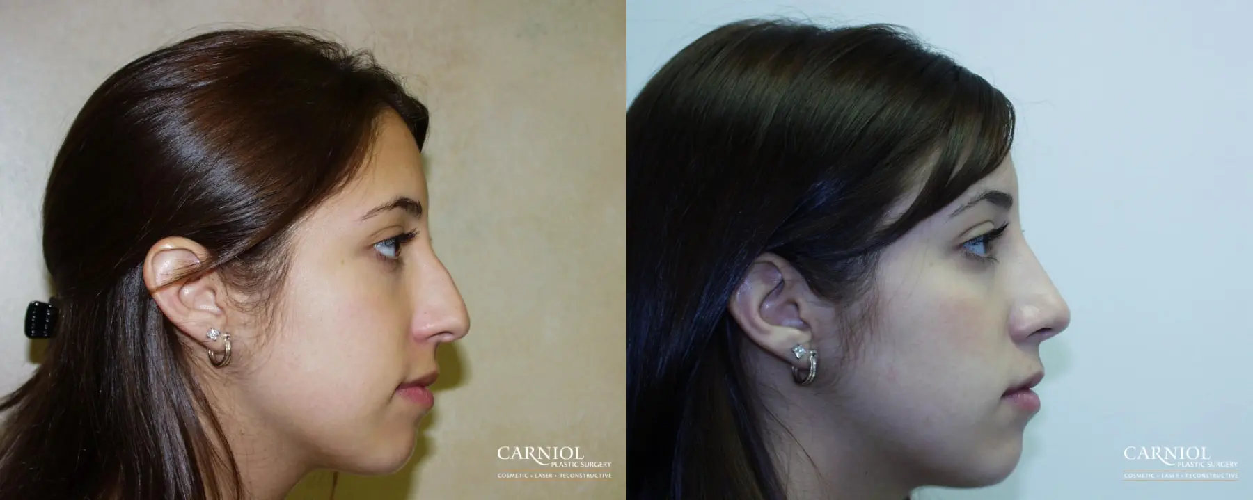 Rhinoplasty: Patient 1 - Before and After  