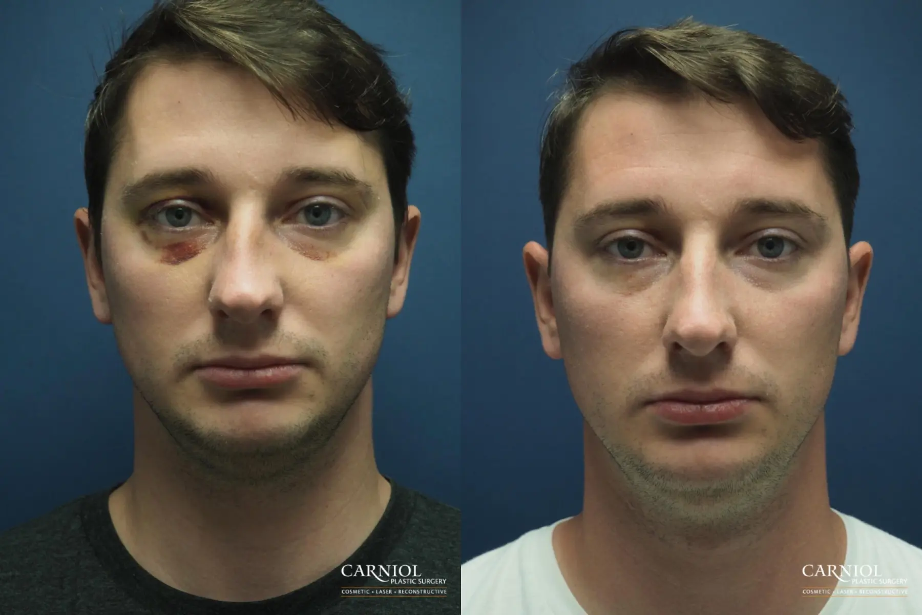 Rhinoplasty: Patient 4 - Before and After  