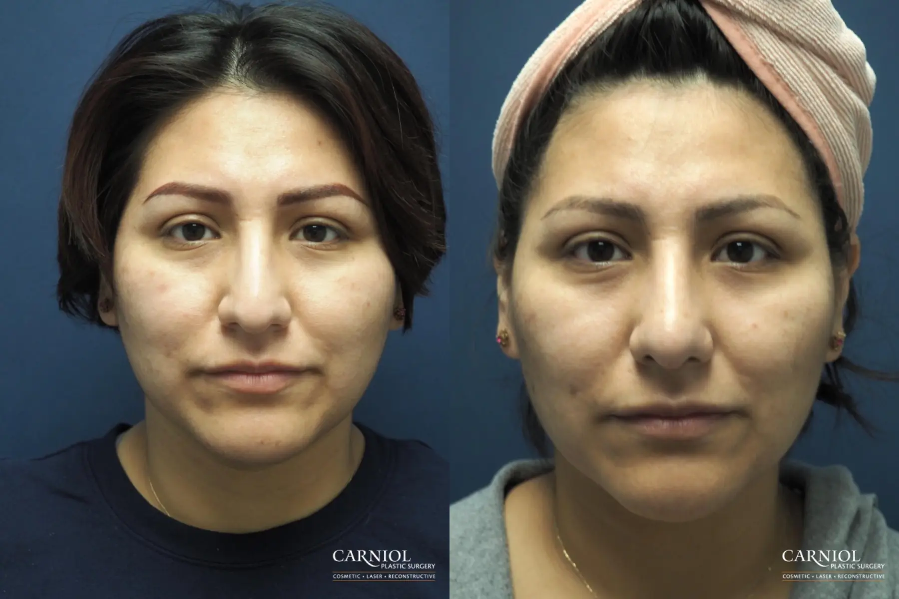 Rhinoplasty: Patient 5 - Before and After  