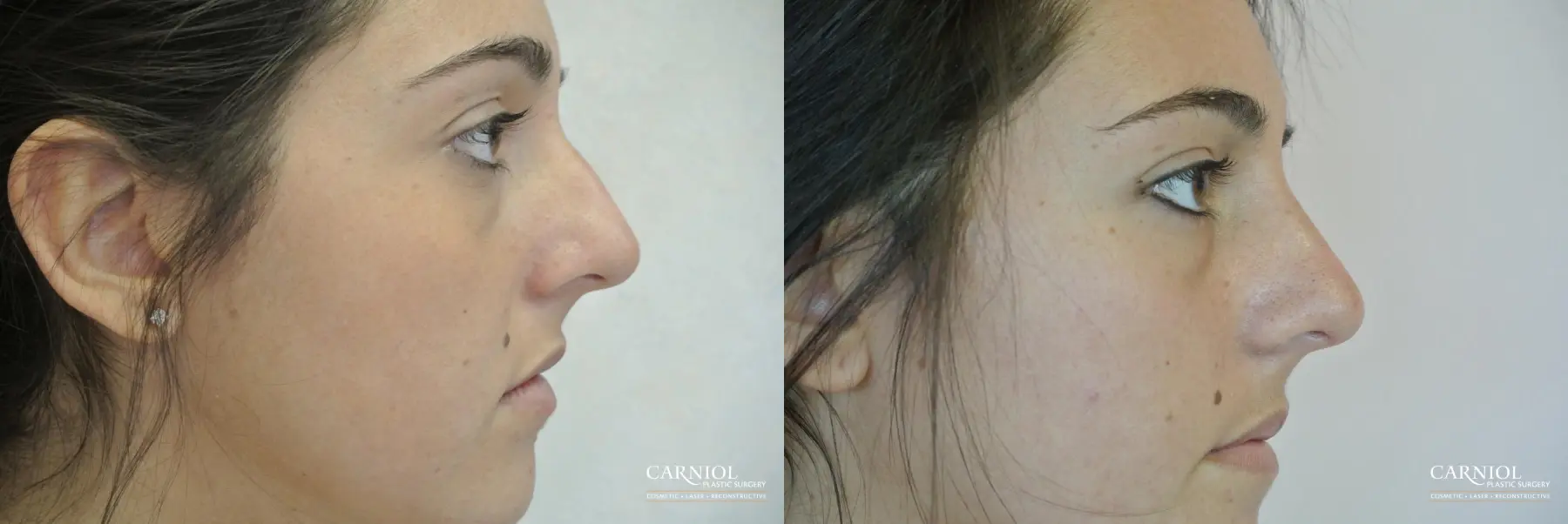 Rhinoplasty: Patient 3 - Before and After  