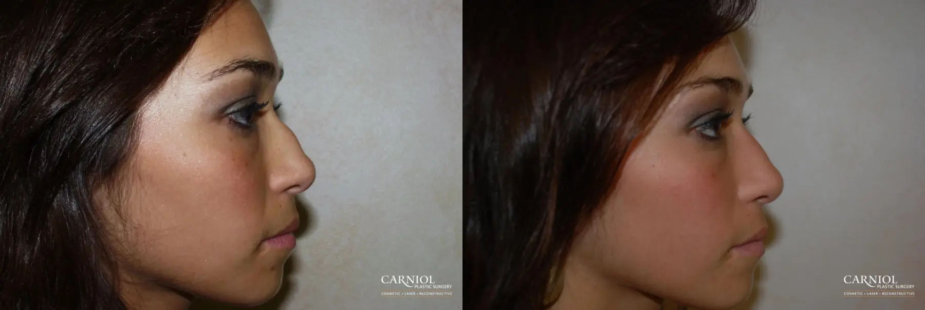 Rhinoplasty: Patient 2 - Before and After  