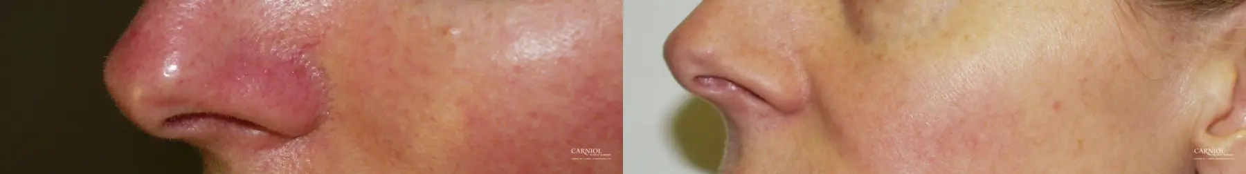 Rosacea: Patient 1 - Before and After  