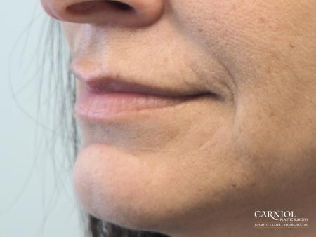 Lip Augmentation: Patient 8 - Before and After Image 3