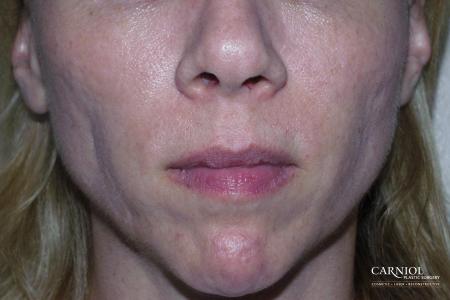 Non-Surgical Mini-Facelift: Patient 8 - Before Image 1