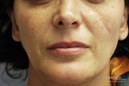 Scar Revision: Patient 1 - Before Image 1