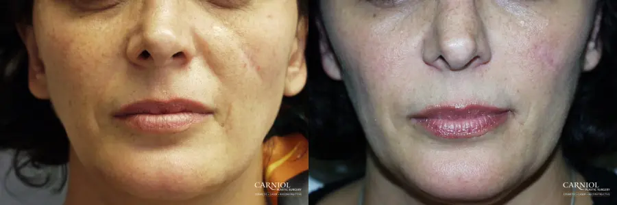 Before After Gallery Summit New Jersey Dr Carniol Board Certified