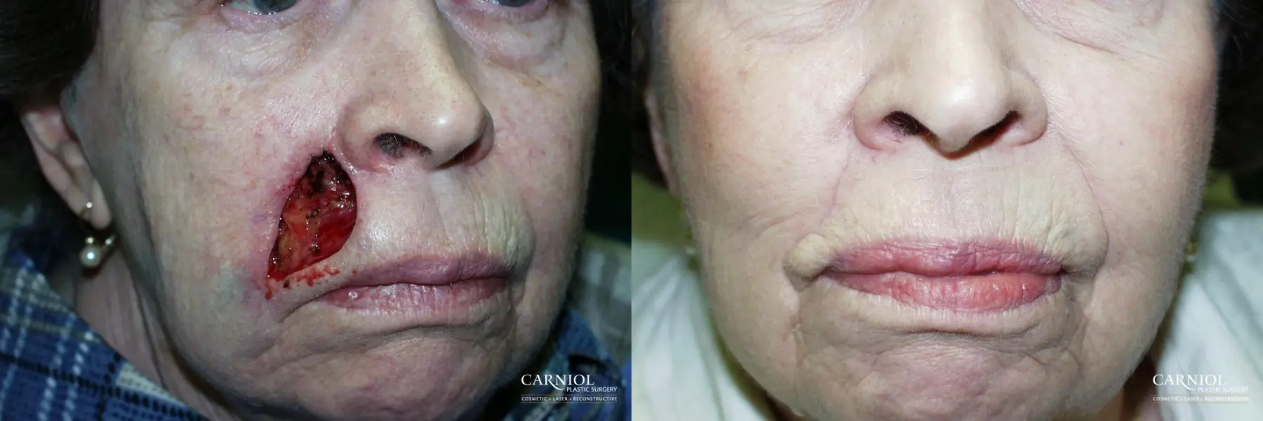 Skin Cancer Reconstruction - Face: Patient 7 - Before and After 1