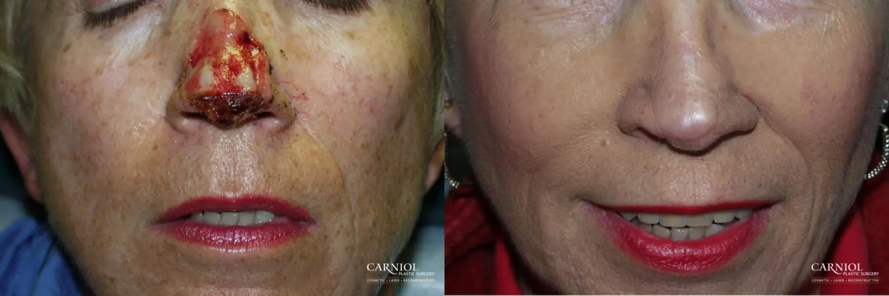 Skin Cancer Reconstruction - Face: Patient 2 - Before and After  