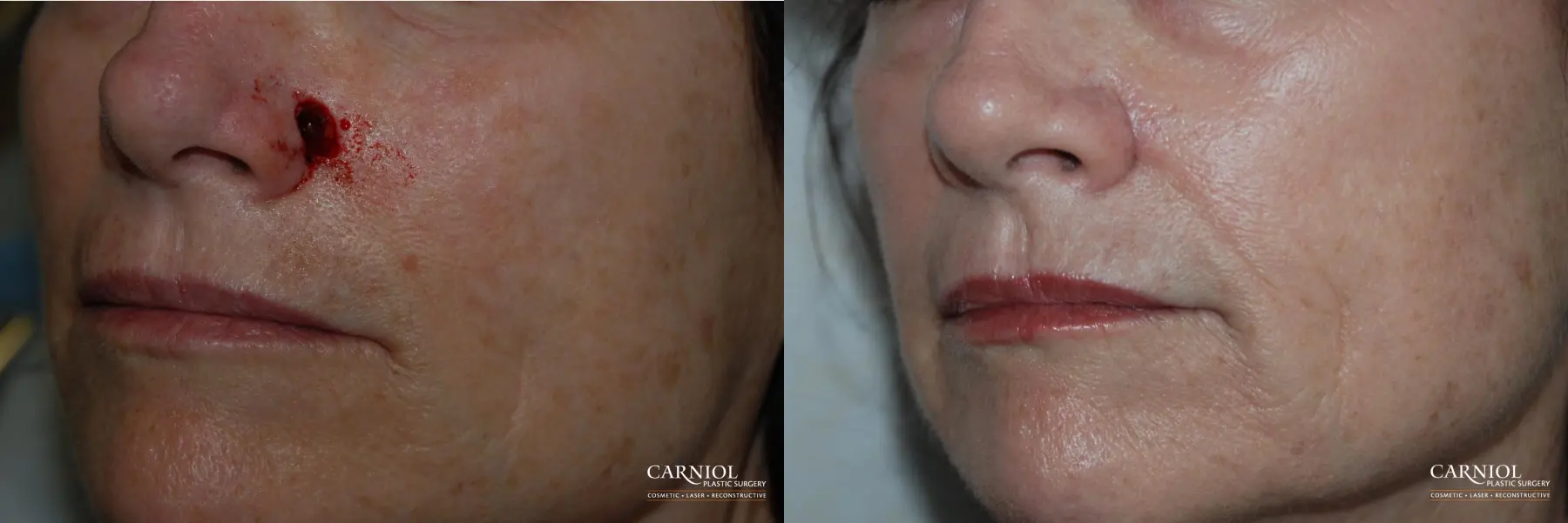 Skin Cancer Reconstruction - Face: Patient 3 - Before and After 1