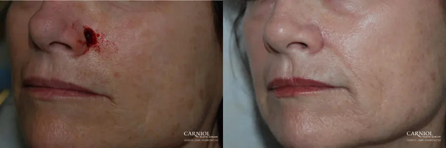 Skin Cancer Reconstruction - Face: Patient 3 - Before and After 1